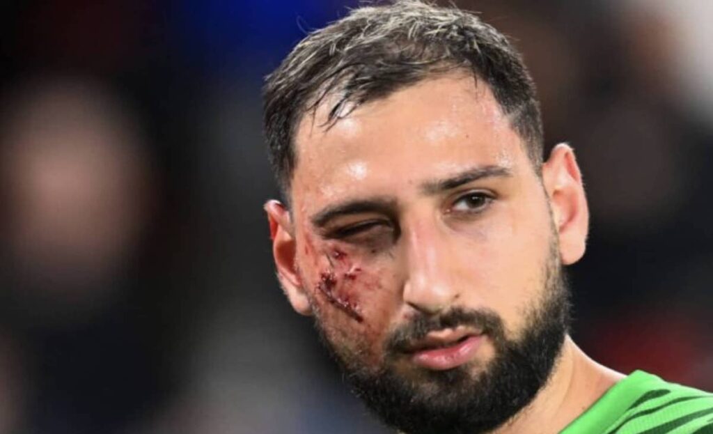 إصابة مروعة لحارس سان جيرمان دوناروما تتسبب في تشويه وجهه